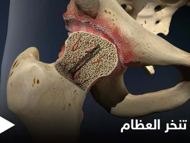 ما هو تنخر العظام.. وماهي أنواعه وأهم الأسباب المؤدية إليه