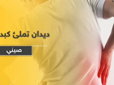 بالصور|| ديدان تملئ كبد رجل صيني.. والأطباء يضطرون لإستئصال جزء كبير منه ويوضحون الأسباب