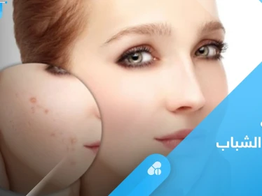 وصفات طبيعية لعلاج حب الشباب تعرف عليها
