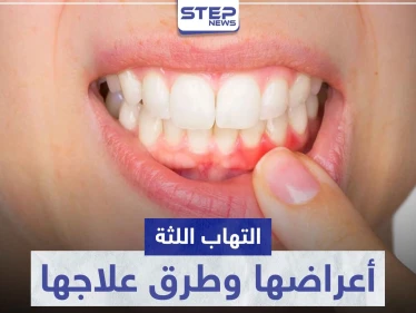 تعرّف على أكثر من كبسول لعلاج التهاب اللثة و ما هي أسبابها وأعراضها