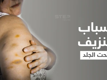 نزيف تحت الجلد... علامات أرجوانية أشبه بالكدمات على الجسم ما هي أسبابها وطرق علاجها