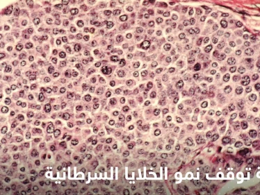 علماء يكتشفون أطعمة توقف نمو الخلايا السرطانية في الجسم وتمنع انتشارها