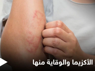 هل تنتشر الأكزيما في الجسم.. وطرق الوقاية منها إليك أهم المعلومات