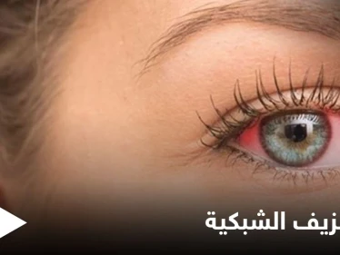 تعرف على علاج نزيف الشبكية بالحقن وطرق أخرى