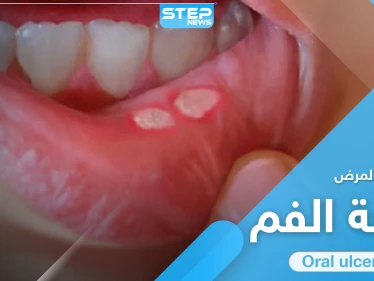 علاج قرحة الفم في المنزل.. إليك الطريقة و7 نصائح هامة