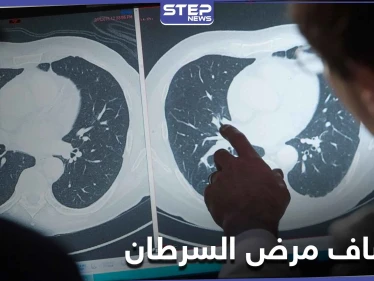علامة تنذر بوجود أورام سرطانية في الجسم قبل ظهورها.. وتمكن من اكتشافها مبكراً