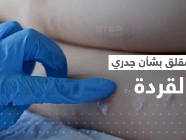 جدري القردة حالة طوارئ دولية.. الصحة العالمية تصدر بياناً "مثيراً للقلق"