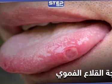 علاجات منزلية مذهلة للتخلص من القلاع الفموي بشكل طبيعي.. إليك 4 طرق