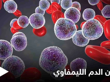 ما هو سرطان الدم الليمفاوي وكيف تظهر أعراضه على المريض إليك أهم المعلومات