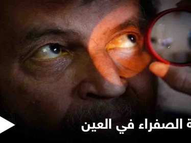 تعرف على أسباب ظهور اللطخة الصفراء في العين وعلاجاتها