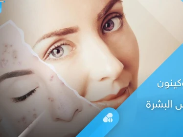 دواء هيدروكينون لتبييض البشرة وإزالة التصبغات.. طرق الاستخدام والآثار الجانبية إليك أهم المعلومات