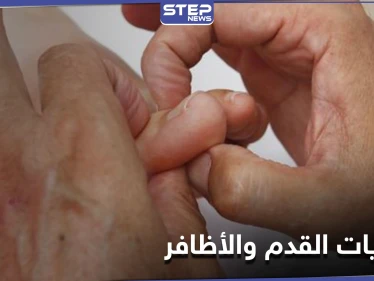 لإيقاف خطر الإصابة بمرض فطريات القدم والأظافر.. إليك 7 نصائح لمكافحته
