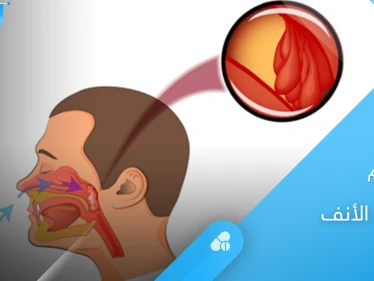 أسباب تضخم لحمية الأنف وطرق اكتشاف اللحمية مبكرًا عند الأطفال