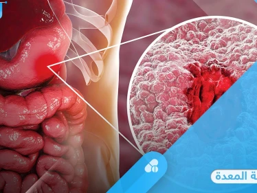 جرثومة المعدة أحد مسببات السرطان والقرحة إليك أسبابها وأعراضها وطرق العلاج