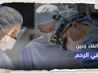 الأولى من نوعها.. جراحة ناجحة لدماغ جنين برحم أمه