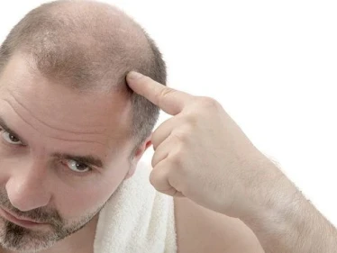 5 أسباب رئيسية تؤدي إلى تساقط الشعر