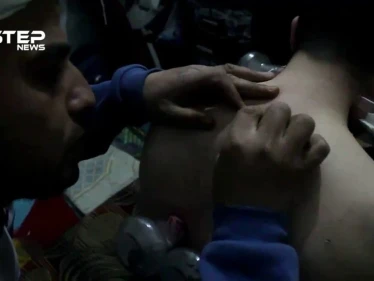 تعرف على الحجامة في مدينة الباب بريف حلب