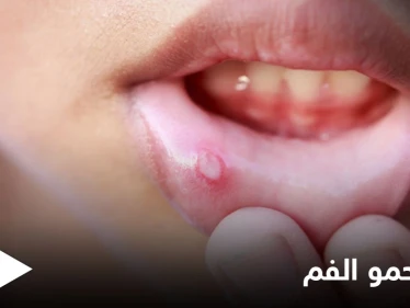 ما هي أسباب ظهور حمو الفم ومتى يكون خطيراً ويحتاج إلى التدخل الطبي إليك أهم المعلومات