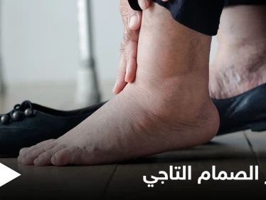 منها تورم القدمين.. تعرف على أعراض قصور الصمام التاجي وأسبابه وطرق العلاج