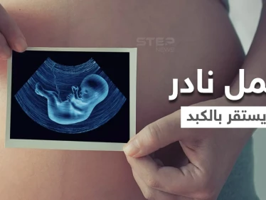 بالفيديو|| بحالة فريدة من نوعها في العالم.. حمل نادر لامرأة خارج الرحم استقر في الكبد
