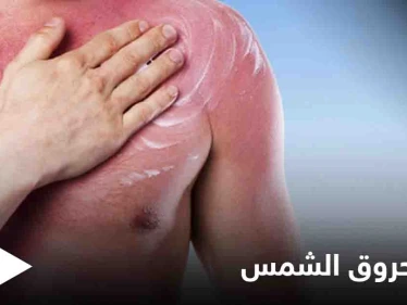 تعرف على أنواع حروق الشمس وأفضل الطرق لعلاجها