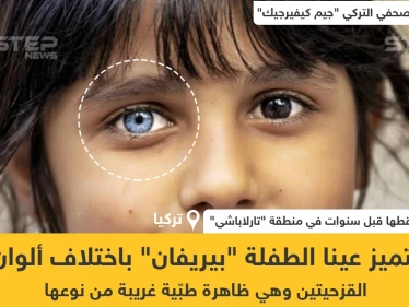 طفلة سورية تتميز باختلاف ألوان عينيها
