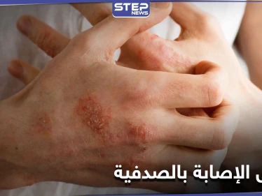 الصدفية تزداد في الفترة الأخيرة.. وهؤلاء الأشخاص هم الأكثر عرضة للإصابة بها