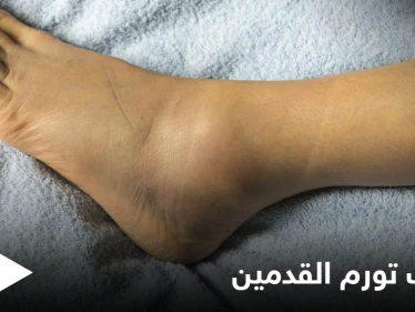 تعرف على أسباب تورم القدمين عند الرجال الأمراض المرتبطة بها