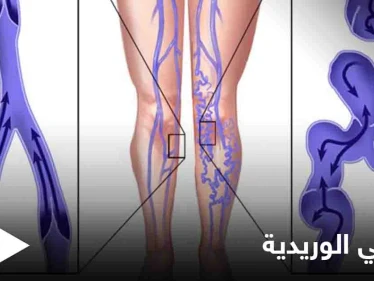 يسبب الكثير من الأعراض المزعجة.. تعرف على مرض الدوالي الوريدية وأسبابه وطرق الوقاية منه