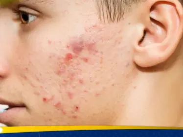 حب الشباب في الشتاء… لماذا يزداد ظهوره وكيف يمكن السيطرة عليه؟ - وكالة ستيب نيوز