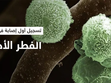 الهند تسجل أول إصابة بالفطر الأخضر في العالم.. وطبيب يشرح أعراضه