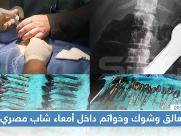 شاب مصري اشتكت والدته من فقدان المعالق والشوك وخاتم ذهبي، فعُثر عليهم داخل معدته!! (صور)