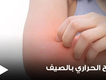 الطفح الحراري في الصيف أعراضه وأسبابه وطرق علاجه