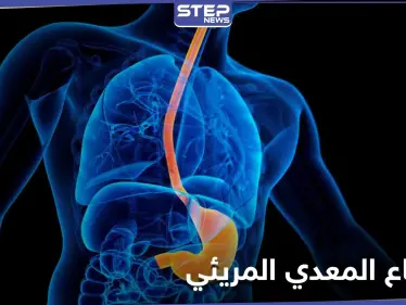 كيف تتخلص من آلام الارتجاع المعدي المريئي وما هي أسبابه وأعراضه الشائعة - وكالة ستيب نيوز