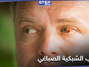 أخطر الإصابات العينية.. التهاب الشبكية الصباغي تعرّف إلى أعراضه وعلاجاته