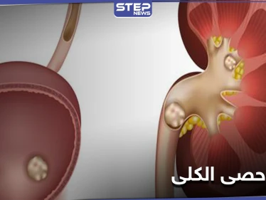 ما لا تعرفه عن حصى الكلى وكيف يمكن معالجتها بالوسائل المنزلية البسيطة