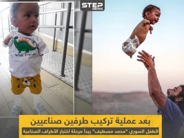 الطفل السوري "محمد مصطيف" بعد عملية تركيب طرفين صناعيين له
