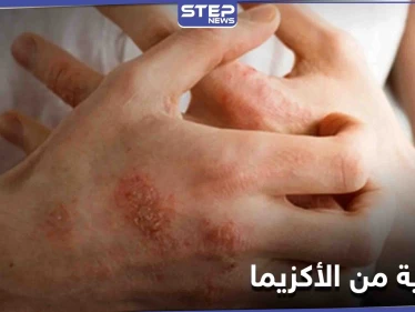 ماهي الأكزيما.. أسباب حدوثها وأهم الطرق للوقاية منها