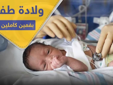 شاهد|| ولادة طفلة بفمين كاملين في حالة طبية نادرة