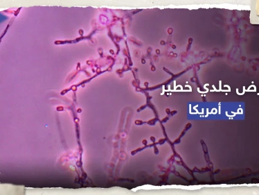 معدي ومقاوم للأدوية.. تسجيل أول إصابتين بمرض جلدي خطير في أمريكا