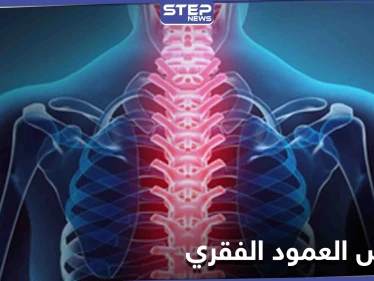 منها السُمنة.. تعرف على أسباب الأمراض التي تصيب العمود الفقري ومدى خطورتها وطرق العلاج