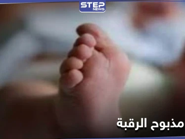 في حالة طبية نادرة .. ولادة طفل مذبوح الرقبة في مصر