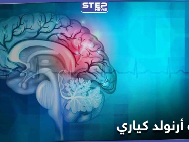 ماذا تعرف عن تشوه أرنولد كياري وأثره على النخاع الشوكي والحركة العضلية