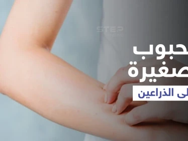 أسباب ظهور حبوب صغيرة على الذراعين وطرق علاجها إليك أهم المعلومات