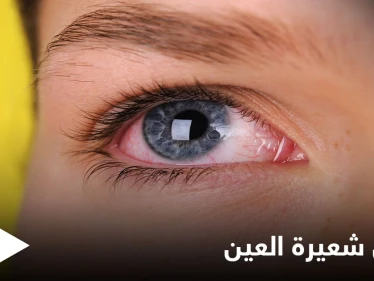 ما هي شعيرة العين وأسباب ظهورها إليك أهم المعلومات