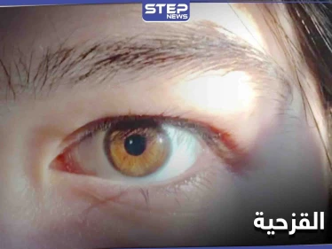 مخاطر مرض غياب القزحية وأسبابه وطرق العلاج