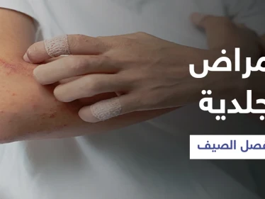 تعرّف على أبرز الأمراض الجلدية الشائعة في فصل الصيف وطرق الوقاية منها