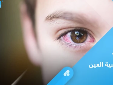تعرف على علاج حساسية العين عند الاطفال بطرق مختلفة