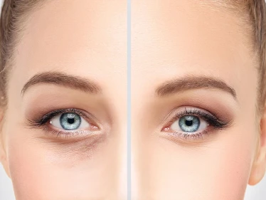 عمليات تجميل العيون .. أنواعها تكلفتها ومخاطرها