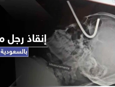 بالصور|| إنقاذ رجل مقيم بالسعودية دخل سيخ تعليق الأضحية بعينه إلى جمجمته